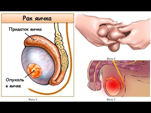 УРУГДОН САРАТОН КАСАЛЛИГИ  РАК