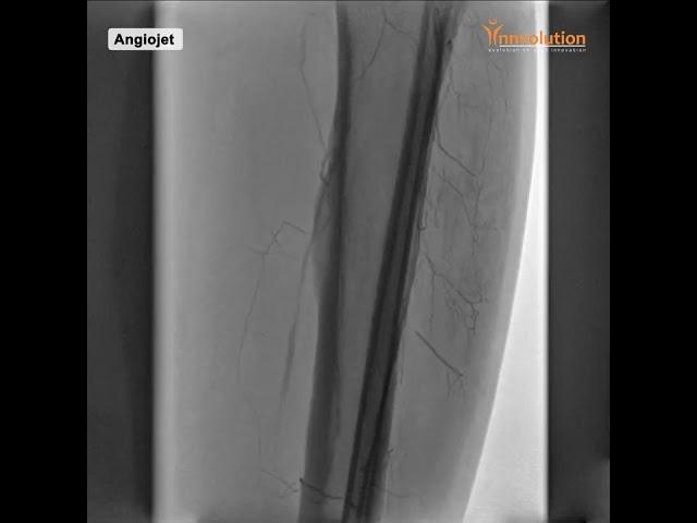 Angiojet performed on our Innvolution Cathlab