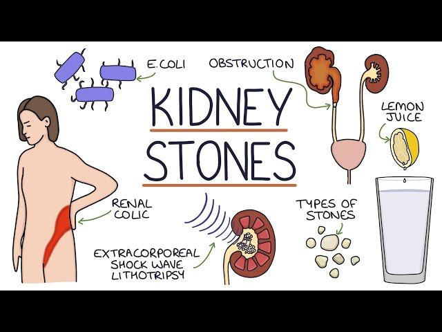 Understanding Kidney Stones