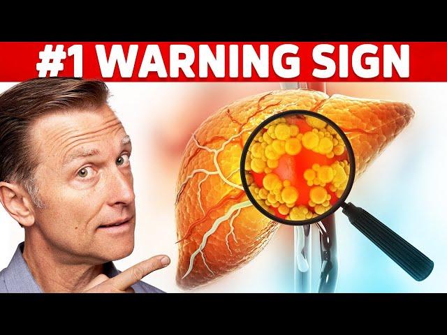 The #1 Top Warning Sign You Have a Fatty Liver