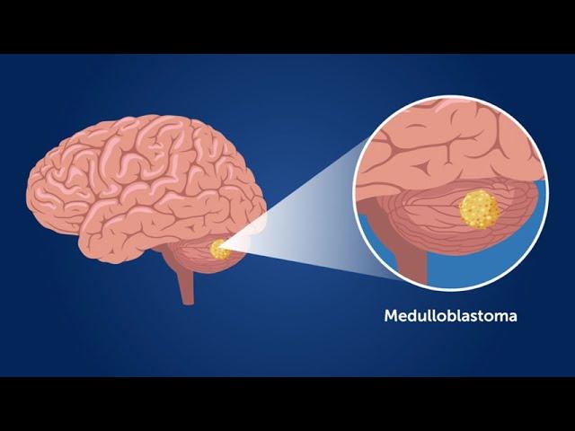 Late-Onset Complications of Childhood Medulloblastoma