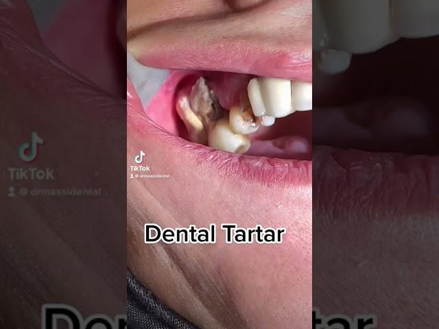 Dental Cleaning, Dental Scaling #tiktok #viral #video #fyp #funny #love #dentist