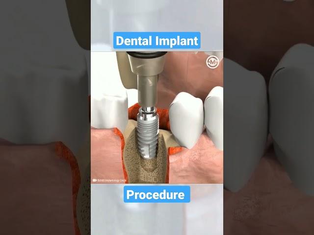 Dental Implant Procedure #dental #dentist #implant #animation #Shorts
