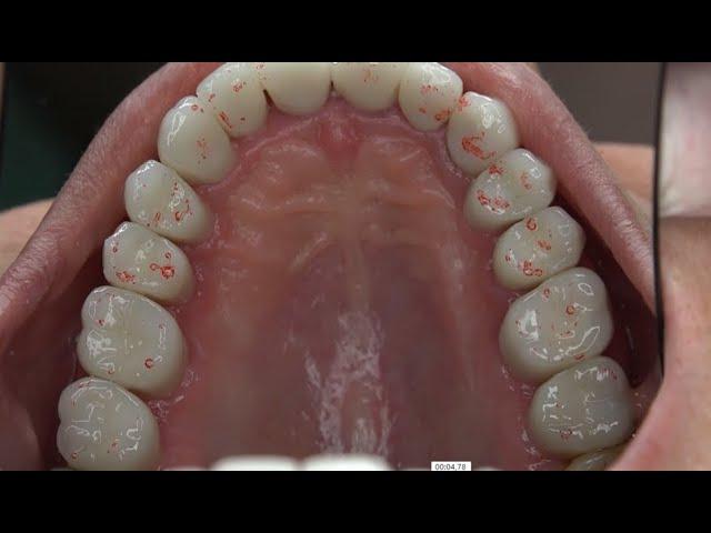 Introduction to Occlusion: Which articulator to prevent occlusal interference?