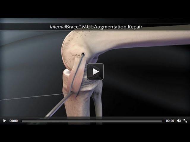 InternalBrace™ MCL Augmentation Repair