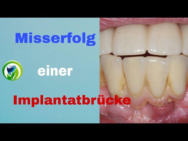 Misserfolg einer Implantatbrücke - Patientenfall | Ursache | Therapieoptionen