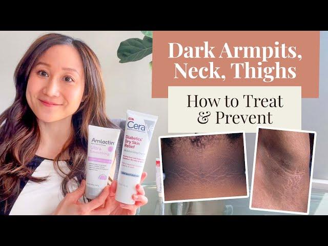 Treating and Preventing Dark Armpits, Thighs, Neck, and Arms | Dr. Jenny Liu