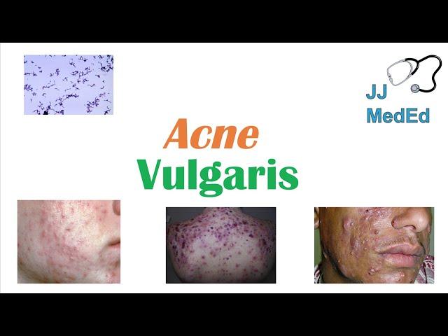 Acne Vulgaris | Causes, Pathogenesis, Influencing Factors, Diagnosis, Treatment and Complications