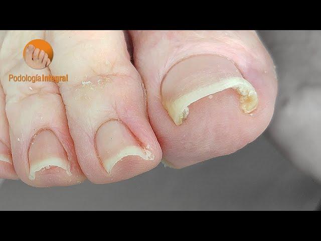 Curved nails [1 year later follow-up]