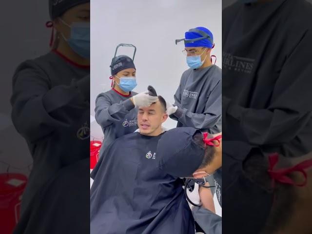 My #hairtransplant journey in colombia  #bogotahairlines #transplantecapilar