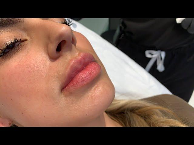 GET THOSE JUICY RUSSIAN LIPS WITH NO DOWNTIME FILLER INJECTIONS | Hollywood, CA | Dr. Jason Emer