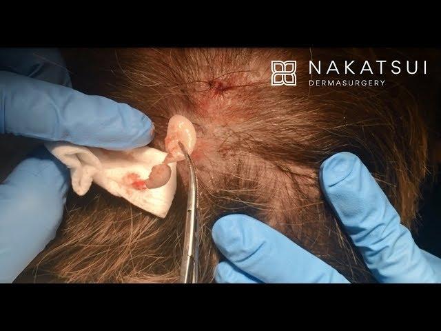 Cyst removal