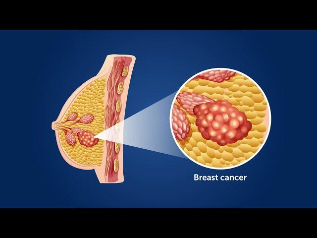 Centralization of Initial Care and Improved Survival of Poor Patients With Breast Cancer