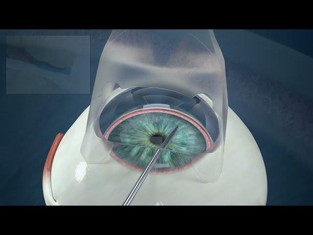 Glaukos iDose TR Procedure Animation