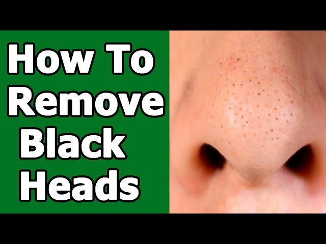 How To Remove Blackheads Naturally With Baking Soda