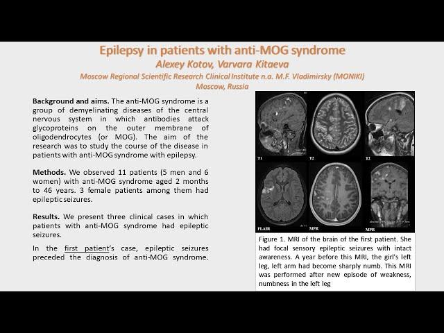 Epilepsy in patients with anti MOG syndrome