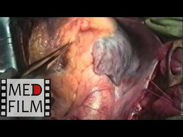 Shunting of the anterior interventricular artery without cardiopulmonary bypass ©