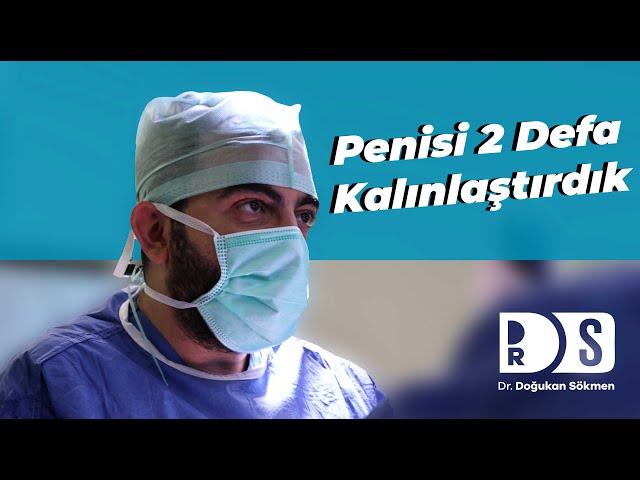 Penis Kalınlaştırma Ameliyatı | HardRock Sandviç İle Penis Kalınlaştırma - Dr. Doğukan Sökmen