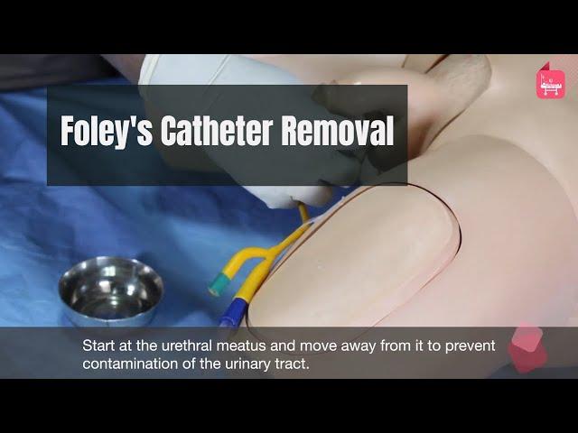 How to Remove urinary (foley's ) catheter (male) ?