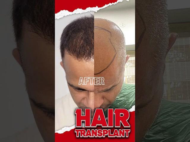 Hair Transplant Surgery: 2-Year Transformation Journey | 2 YEARS LATER: UNBELIEVABLE RESULTS!