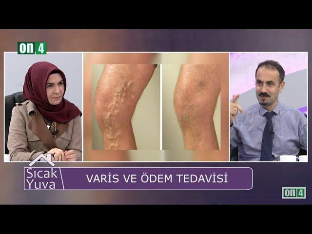 VARİS GELİŞİMİNİ KOLAYLAŞTIRAN SEBEPLER VE VARİS TEDAVİSİ - PROF DR AHMET KARABULUT