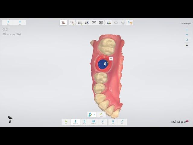 3Shape TRIOS- Implant restoration workflow IT