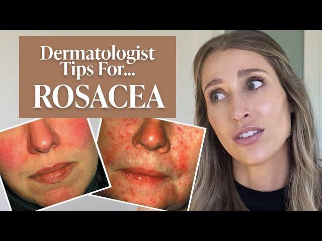 Dermatologist’s Guide to Rosacea: What Is It, Dos & Don’ts, Treatment Tips, & More! | Dr. Sam Ellis