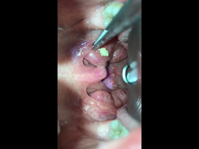 Tonsil stone removal