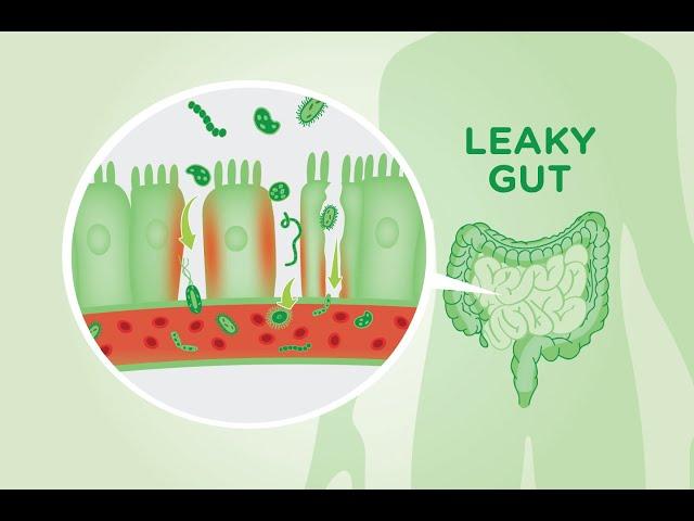 5 Causes of A Leaky Gut And The Symptoms it Causes