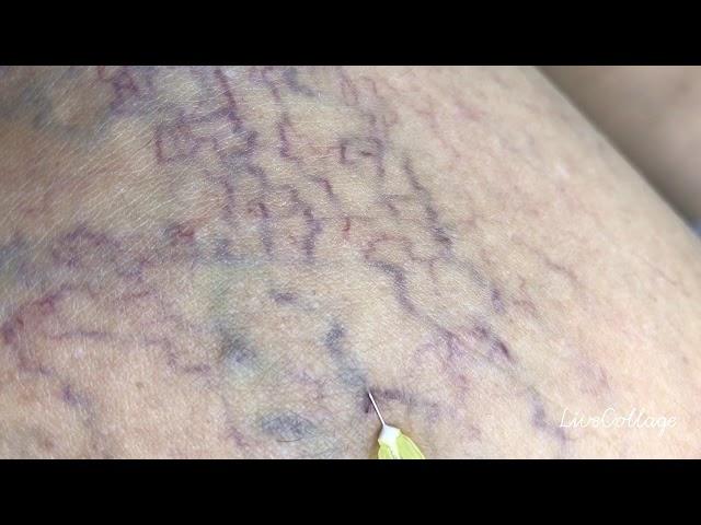 Micro sclerotherapy for spider veins