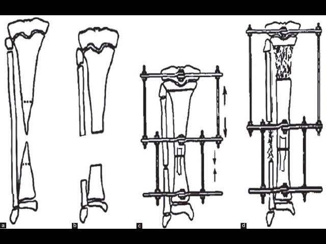 ShortCuts:'Ilizarov Apparatus'