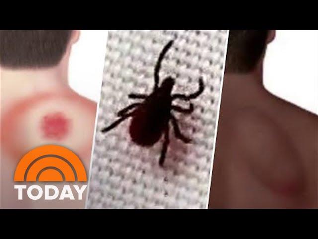 Important Tips To Protect You From Ticks And The Diseases They Carry