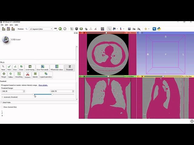 3D Slicer Demonstration- CT Scan/MRI to 3D Model - .stl file