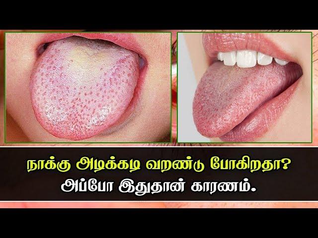 Dry Mouth - Causes, Symptoms Treatments & More | நாக்கு அடிக்கடி வறண்டு போகுதா? | AzhaghuTamil