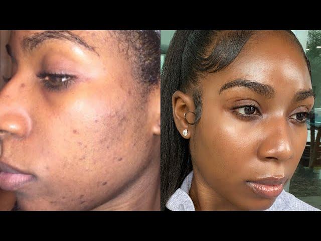 HOW I CLEARED MY ACNE & HYPERPIGMENTATION | GLASS SKIN SKINCARE ROUTINE
