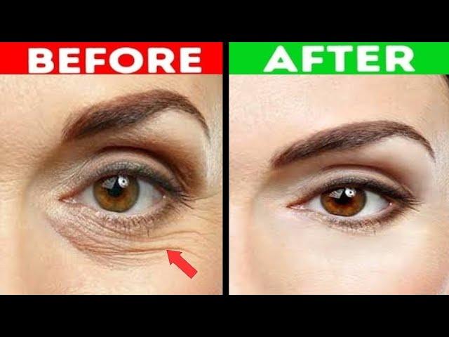 Reasons and Treatment Of wrinkle and Fine lines under the eyes |Dr.Vivek Joshi