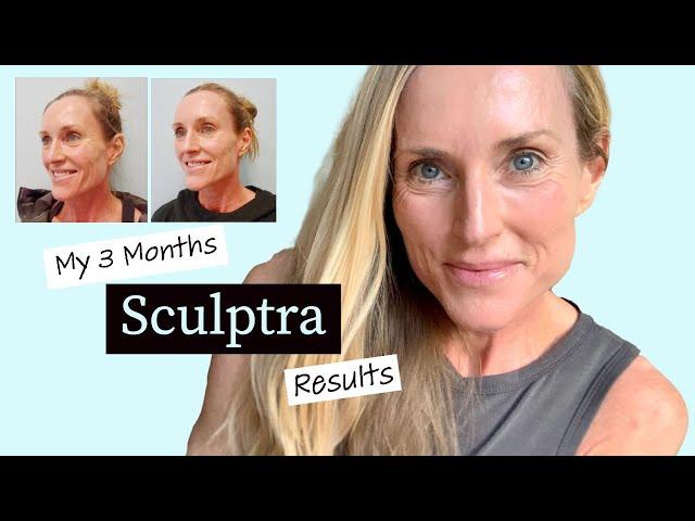 My 3 months SCULPTRA update with BEFORE & AFTER Pictures