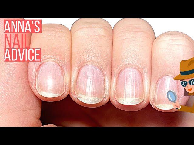 PEELING, BENDY NAILS? WHAT DO I DO?! ANNA, HELP!! [ANNA'S NAIL ADVICE]