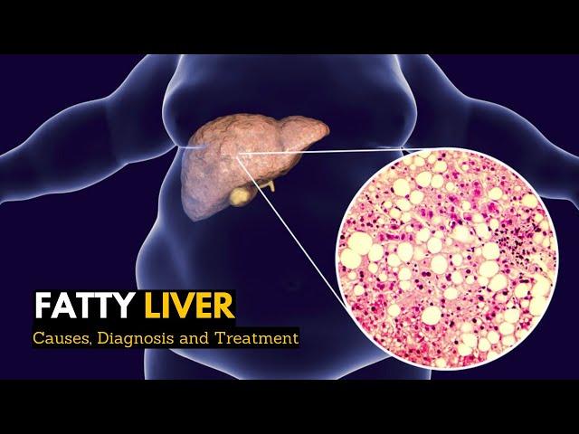 Fatty Liver, Causes, Signs and Symptoms, Diagnosis and Treatment.