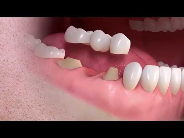 Straumann - Conventional 3-unit bridge treatment