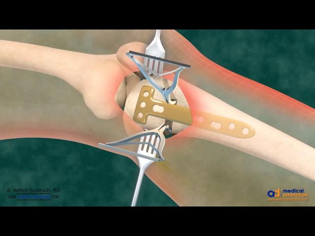 High Tibial Osteotomy (HTO) for Bow Leg Correction