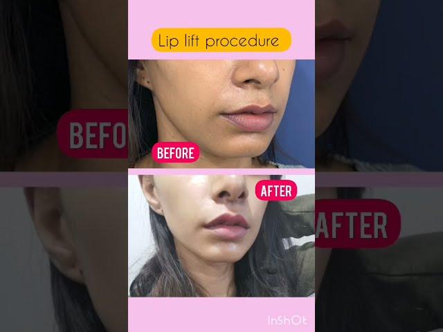 Lip Lift - Amazing Results #shorts #liplift #lips