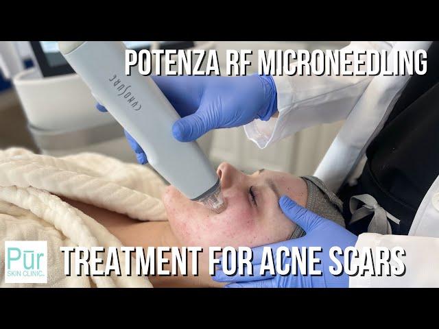 TREATMENT FOR ACNE SCARS | Potenza RF Microneedling in Edmonds, WA | PUR Skin Clinic