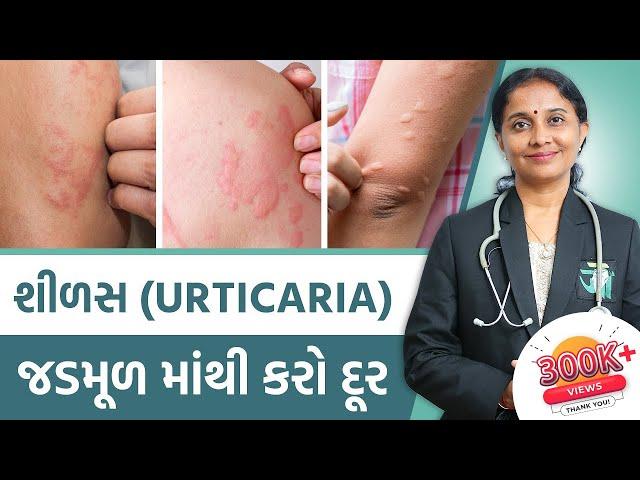 Ayurvedic Treatment Of Urticaria  | Dr. Devangi Jogal | JOGI Ayurved