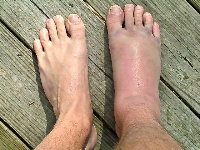 SPRAINED or BROKEN Ankle? : *Doctor Guide!*