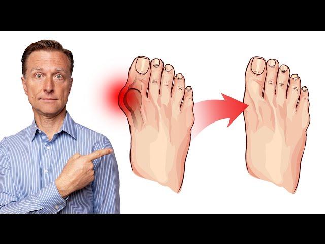 How to Fix Bunions in 3 Steps