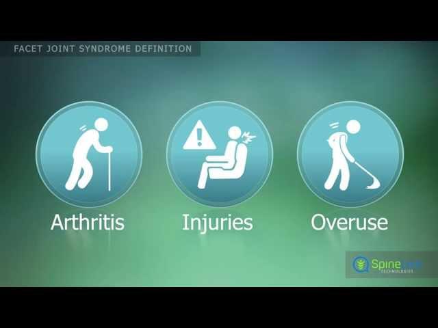 Facet Joint Syndrome Definition