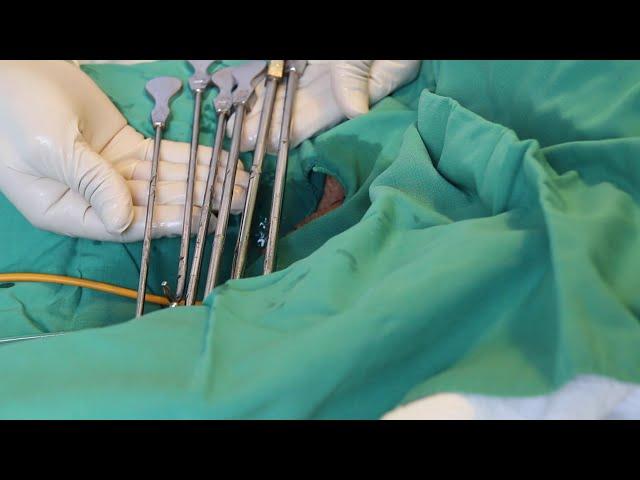Meatal Stenosis: Difficult Catheterization and Dilation
