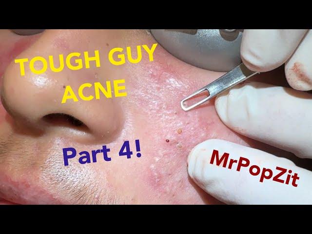 Tough Guy Acne part 4!Acne extractions.Make an appointment with me, details in description! Lets go!