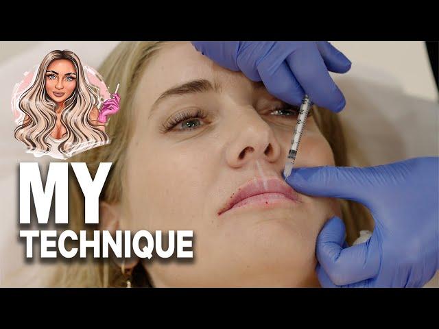 Watch this full treatment of RUSSIAN LIPS | Dermal filler - Before & after